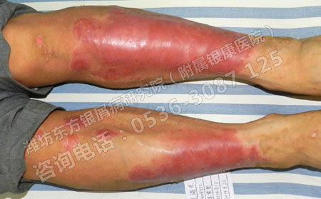 潍坊看银屑病的专科医院