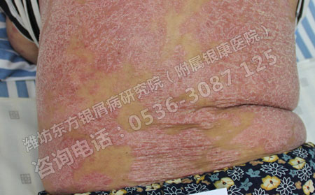 如何提高银屑病患者的睡眠质量