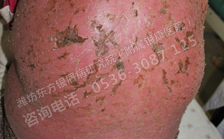 潍坊银屑病患者治疗防骗小妙招