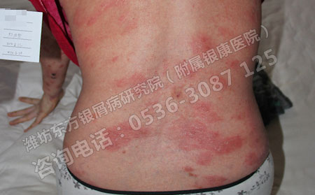 怎样让自己的银屑病可以得更快