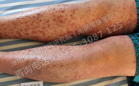 潍坊治疗银屑病的非常好医院是