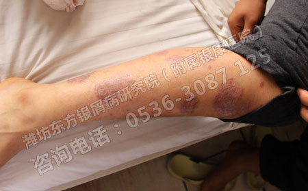 两个月了银屑病还没可以