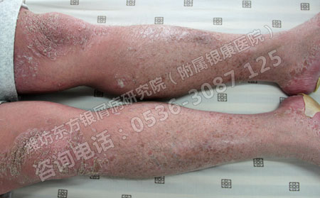 老人银屑病患者的怎样科学护理