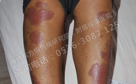 男性牛皮癣能治断根吗?