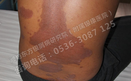 潍坊哪家医院看银屑病费用低