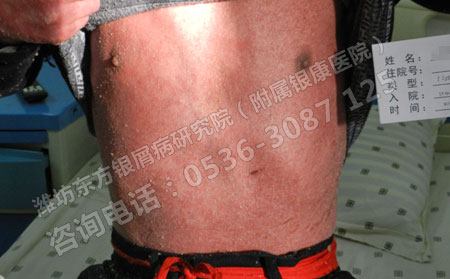 去潍坊银屑病医院怎么走
