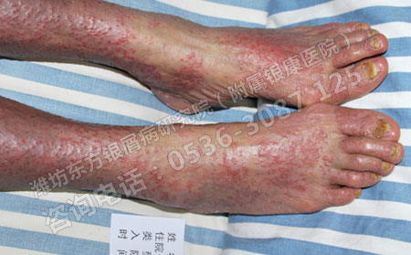 除了治疗之外银屑病还要注意些什么