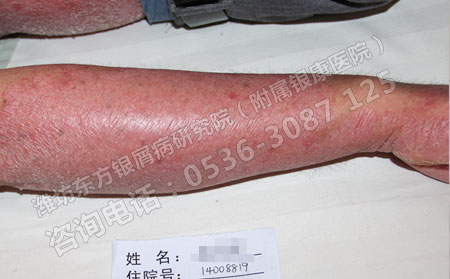 潍坊轻微牛皮癣要怎样治疗