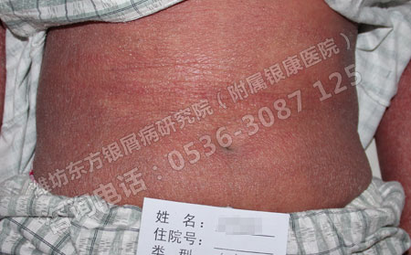 潍坊什么医院看银癣病非常好