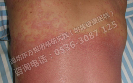 不利于防治牛皮癣的生活方式有哪些