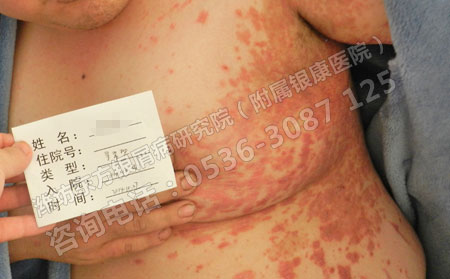 银屑病患者为什么不能随便使用维生素A