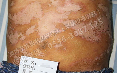 中重度银屑病复发更加频繁，原因是什么?