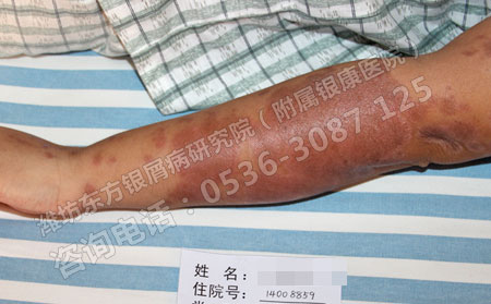 患者实用的防治牛皮癣方法