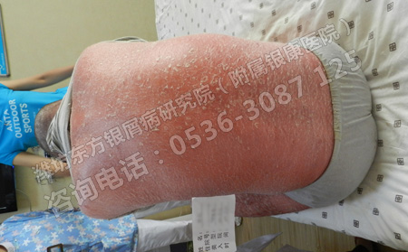 如何让牛皮癣患者走出暴晒治疗的错误认识