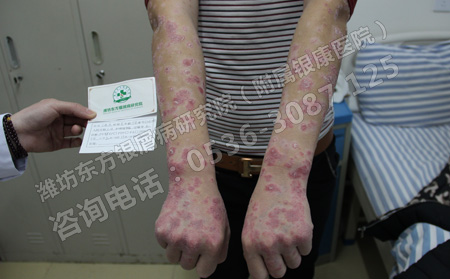 夏天刚得银屑病，可以不治自己恢复吗