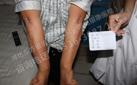 银屑病患者夏天容易犯哪些认识上的错误