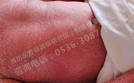 是什么导致老年人患上牛皮癣