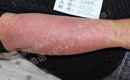 牛皮癣夏天护理方法大全