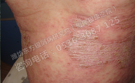 牛皮癣应该怎样正确治疗