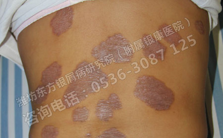 环境和牛皮癣有什么关系