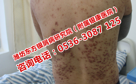 牛皮癣患者哪些症状表面牛皮癣开始恢复