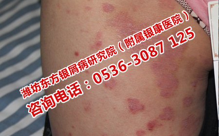 导致牛皮癣复发的因素是什么