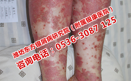 儿童牛皮癣应该怎样治疗