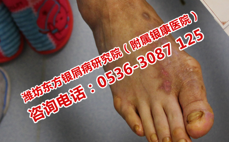 潍坊哪家医院治疗牛皮癣较专业