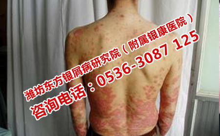 专门治疗牛皮癣的大医院