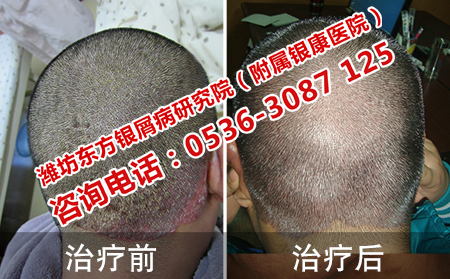 头部患有牛皮癣去哪家医院治疗才有效