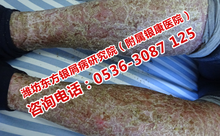 牛皮癣有什么症状表现
