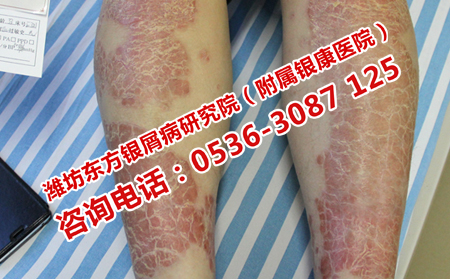 牛皮癣患者日常应该怎样补充营养？
