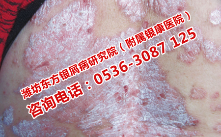 牛皮癣患者应该怎样护理