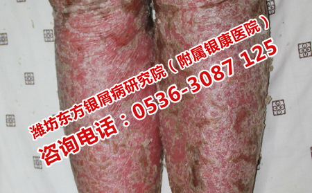 牛皮癣患者在生活中应该注意哪些问题