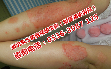 银屑病基本可以了慢与什么相关