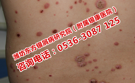 潍坊治疗牛皮癣的可以医院