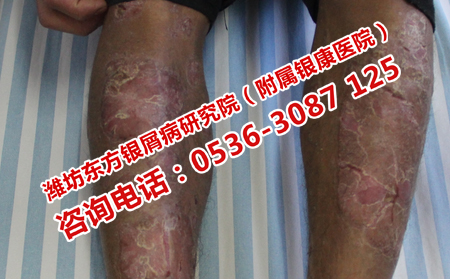如何防治减少牛皮癣复发