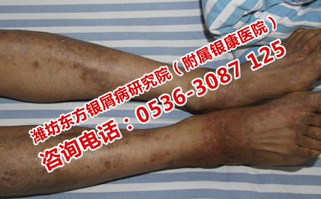 夏天护理银屑病性关节炎