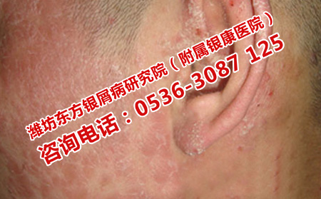 潍坊银屑病医院的全国排名