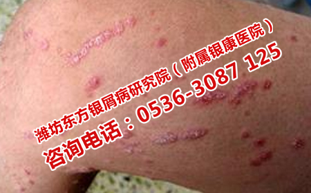 突发点滴状牛皮癣如何治疗