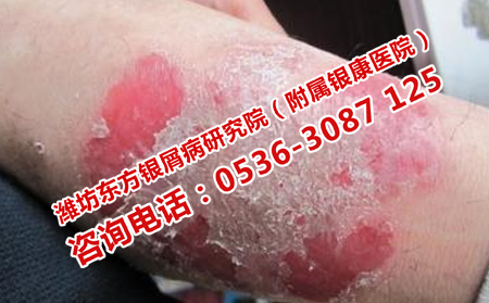 牛皮癣自己诊断的依据
