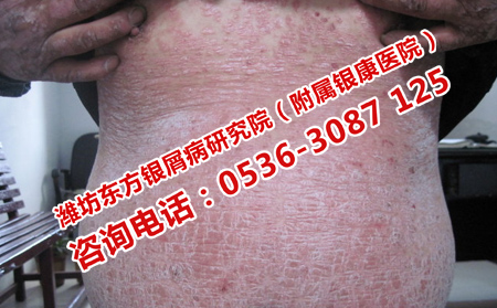 牛皮癣患者淋雨之后如何处理