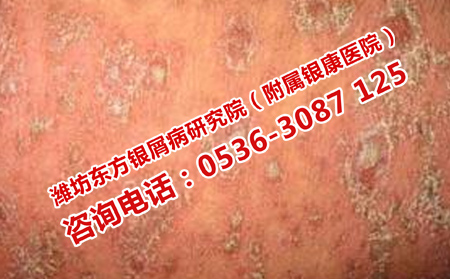 牛皮癣复发该如何防治