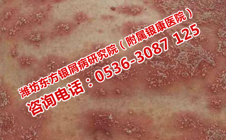 如何遏制扩散的牛皮癣