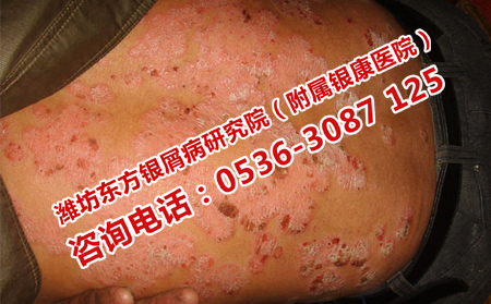 采取哪些措施预防牛皮癣复发
