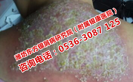 容易被忽视的银屑病危害