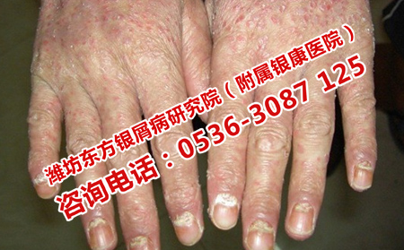 潍坊首先选择的牛皮癣医院
