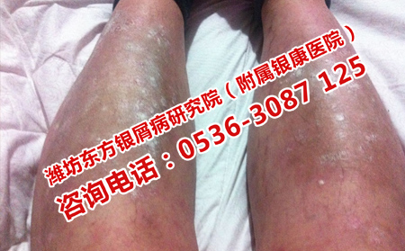 复发性牛皮癣的治疗