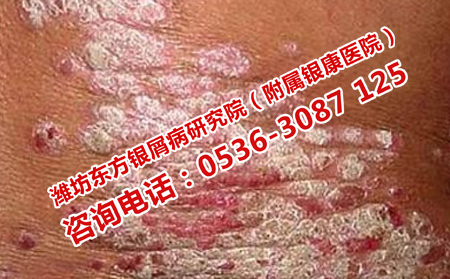 寒亭可以治牛皮癣的地方