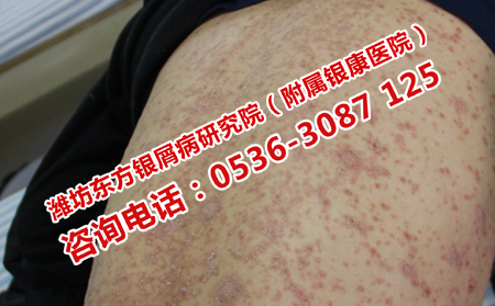 初发牛皮癣的症状